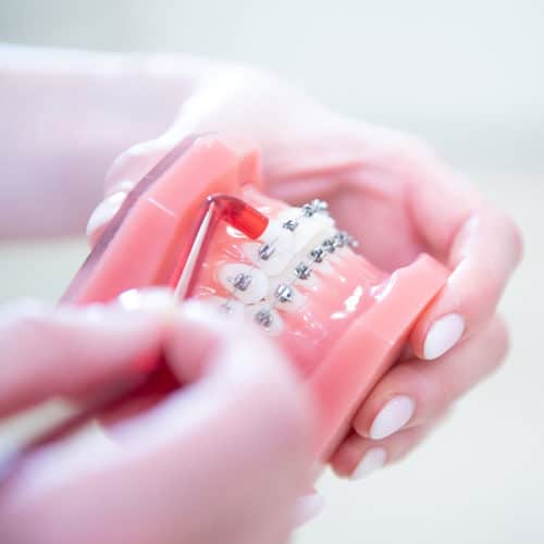 KFO Stelz | Die richtige Zahnpflege bei einer festen Zahnspange